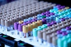 Colesterol alto: por qué casi nunca da señales y cómo detectarlo a tiempo, según el IMSS
